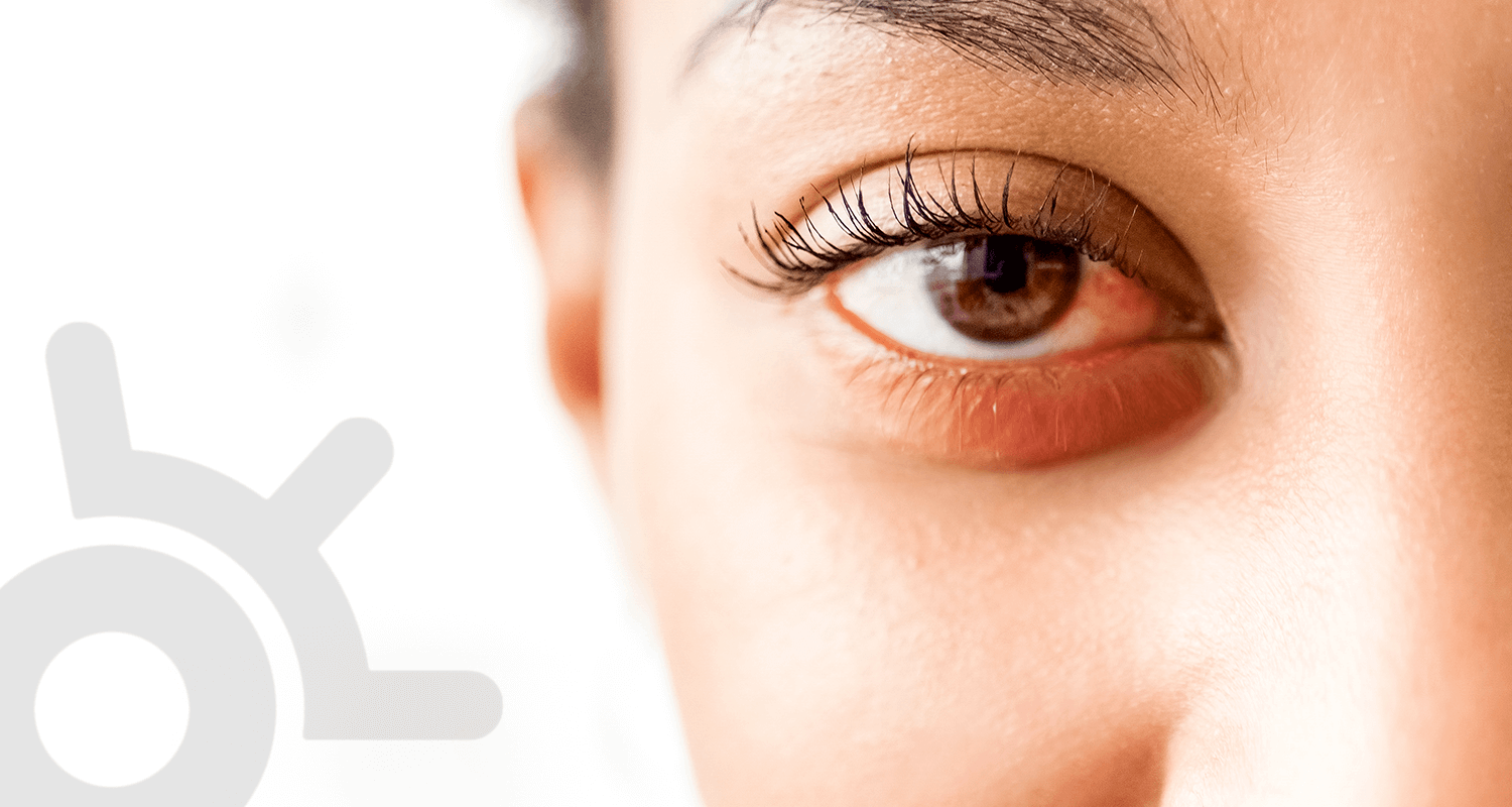 Capa blog conjuntivite