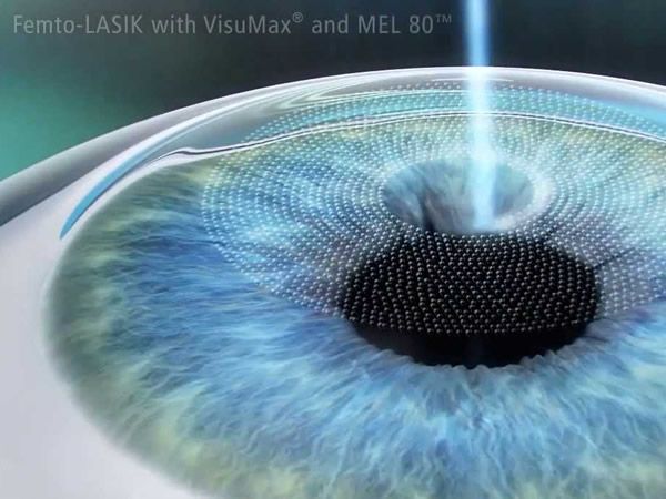 cirurgia femto lasik em ponta grossa