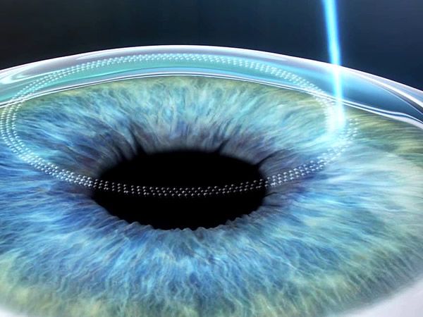 cirurgia refrativa em ponta grossa