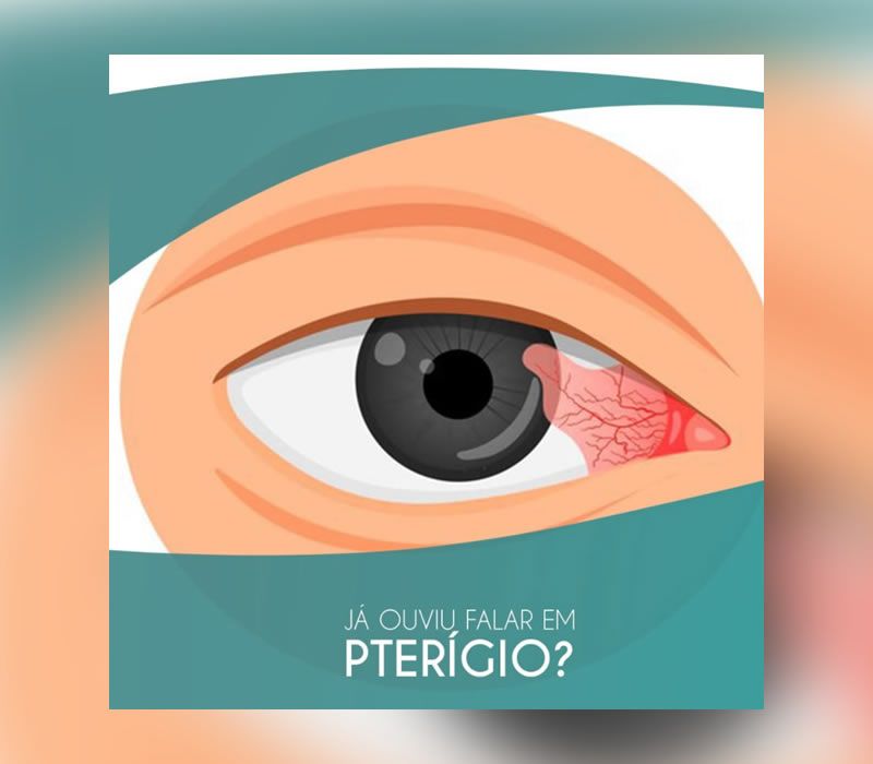 Tratamento de Pterigio em Ponta Grossa