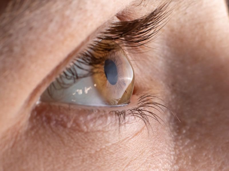 crosslinking para ceratocone tratamento em ponta grossa