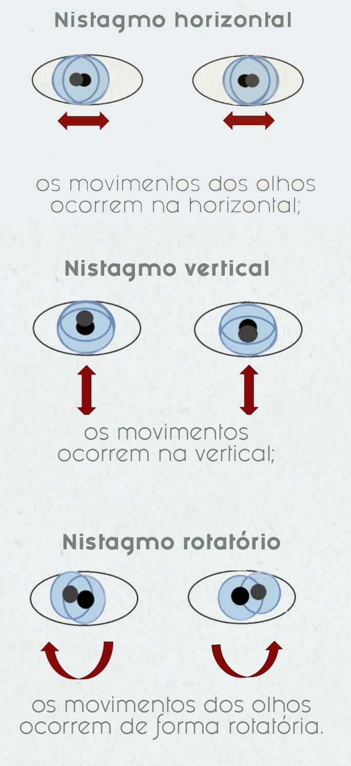 nistagmo tratamento ponta grossa