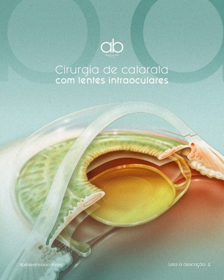 lentes intraoculares catarata ponta grossa