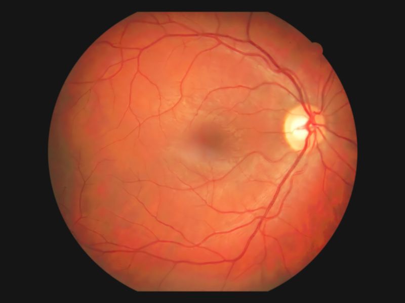 Tratamentos de Retina em Ponta Grossa Doencas Incomuns que afetam a Retina