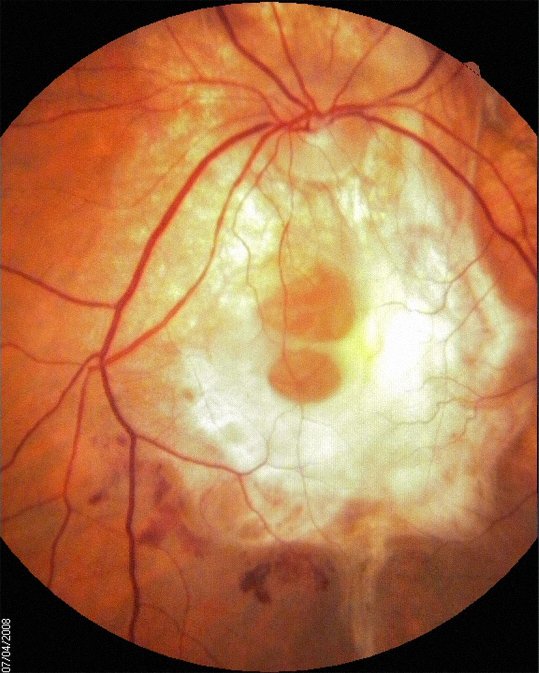 degeneração macular relacionada a idade tratamento oftalmologico especializado em ponta grossa