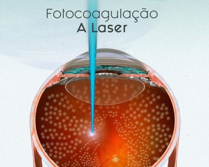 fotocoagulacao a laser em ponta grossa doencas de retina
