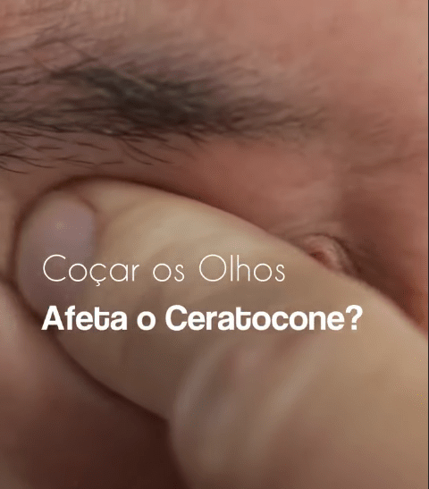 Cocar os Olhos afeta o Ceratocone e1675973296679