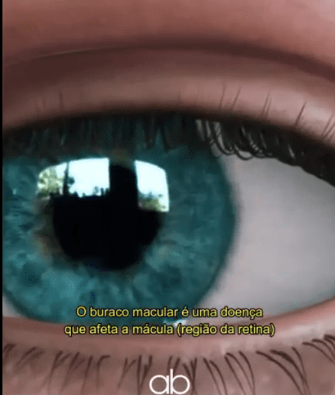 Doencas que Podem Atingir a Macula e1675973198169