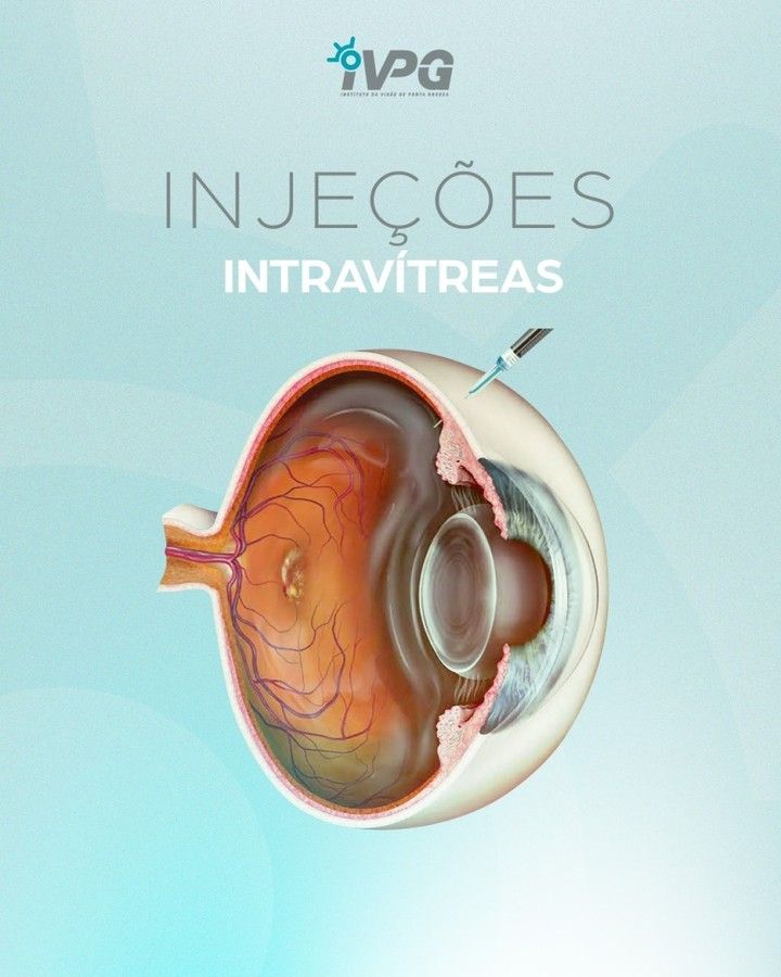 Saiba como as Injecoes Intravitreas sao Utilizadas na Cirurgia Ocular
