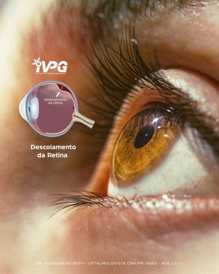 Veja Como Ocorre o Descolamento da Retina e Confira o Tratamento