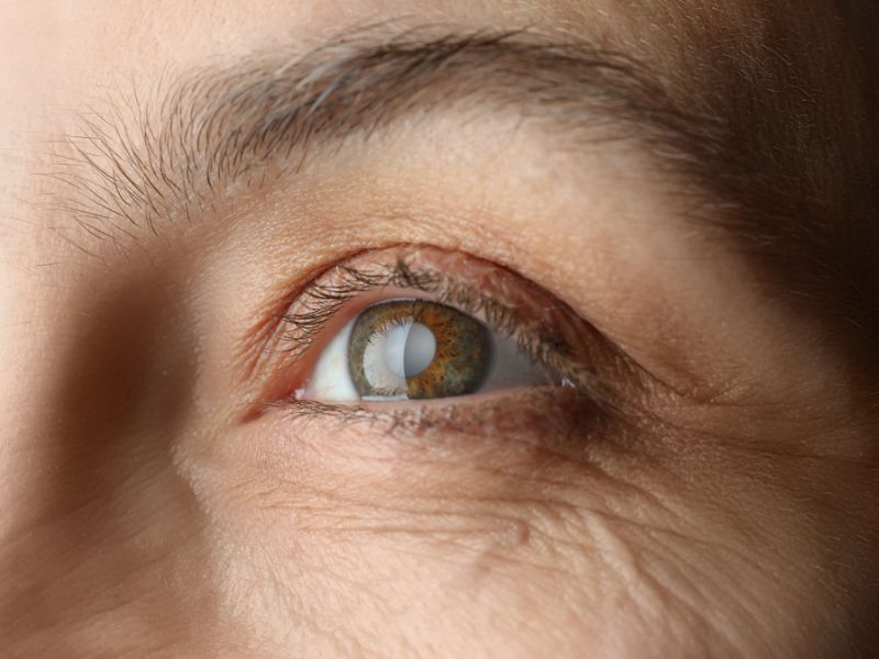 Cirurgia de Catarata com Facoemulsificacao em Ponta Grossa