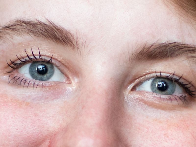 Tratamento de Glaucoma em Ponta Grossa