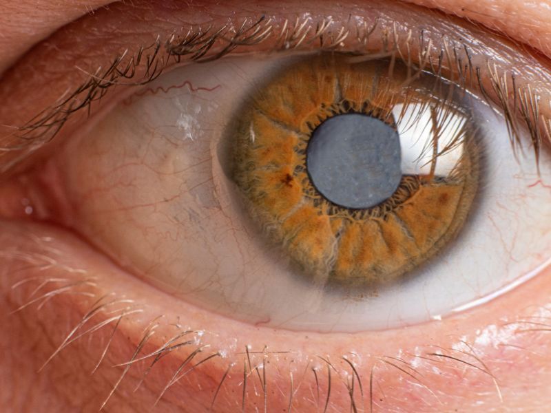 Tudo o que voce precisa saber sobre cirurgia de catarata em Ponta Grossa