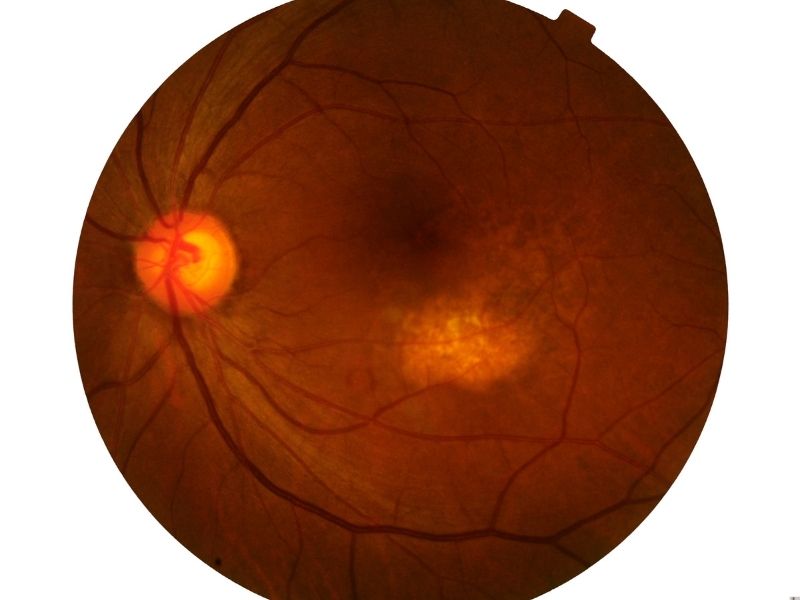 Cirurgia de Retina e Vítreo em Ponta Grossa vitrectomia com precisão e cuidado no IVPG